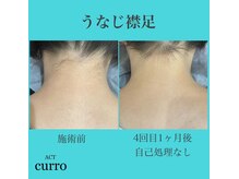 アクト クロ(ACT curro)/【うなじ襟足】施術例