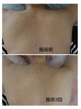 クリアビューティー(CLEAR BEAUTY)/リベルハーブピーリング/背中