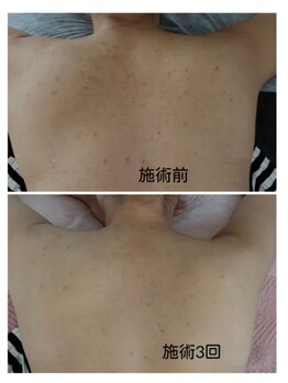 クリアビューティー(CLEAR BEAUTY)/リベルハーブピーリング/背中