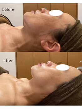 のむら/光フェイシャル&ゾンビパック