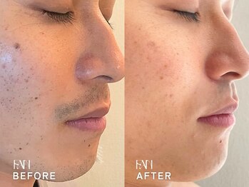 ファン(FAN)/【メンズひげ脱毛】BEFORE-AFTER