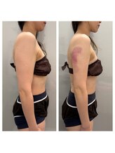 ベル(belle)/【全身】脂肪冷却