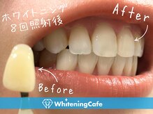 ホワイトニングカフェ 豊橋店/◎歯のホワイトニング施術写真◎
