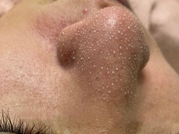 ゆるりの写真/【衝撃の陶器肌】毛穴洗浄×韓国式ハーブピーリング!ミ緩和&赤み少なめ◎本気で肌を変える濃厚なお時間を★