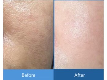 ローズドゥシャロン(Rose de CHALON)/毛穴・くすみも改善★