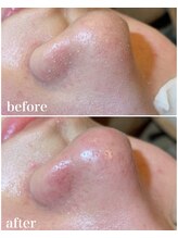 トータルビューティーサロン シフォン(Cfon)/お肌の黒いポツポツケア