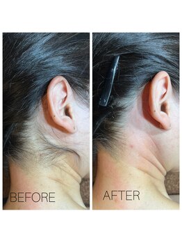 ココリ(CoCoRe)/うなじMIX脱毛