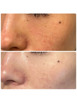 リコ(Relaxation Boutique LICO)/ピーリング☆フェイシャル