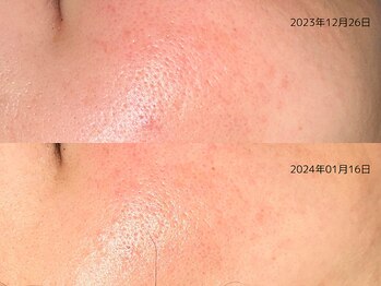 レイル(REIR)/上:施術3回目、下:施術4回目