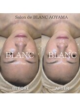 サロン ド ブラン アオヤマ(Salon de BLANC AOYAMA)/剥けないハーブピーリング