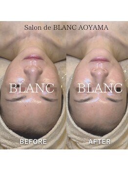 サロン ド ブラン アオヤマ(Salon de BLANC AOYAMA)/剥けないハーブピーリング