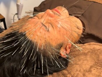 サス(SASU)の写真/都内で施術可能な希少店★ルート鬼美容鍼で人相までかわる大変化を★懐かしい顔を取り戻します。