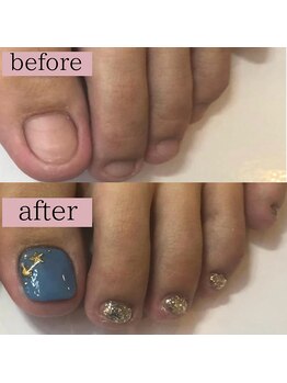 ティアラネイル 宇都宮/足の深爪矯正