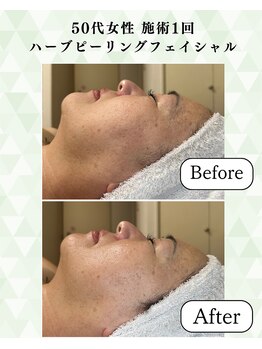 シーフェイス 横浜店(SEE FACE)/肌質改善!肌荒れケア!ハーブ