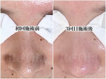 ニュートラル(neutral)/毛穴エクストラクションプロ大分