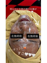 クレール 小山店(CLAIR)/【リフトアップ・小顔】