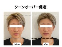 シン(SHINE)/美容鍼灸