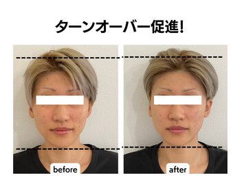 シン(SHINE)/美容鍼灸