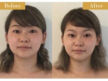モモスパ(MOMOspa.)/頭蓋骨小顔矯正ビフォアフター