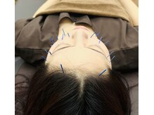 502鍼灸院/美容鍼