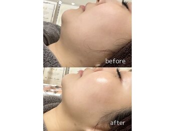 パールフェイスエステ ルペルル(PEARL FACE ESTHE la perle)/むくみ改善