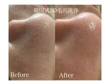 ビューティーバーコア(Beauty bar KOA)/韓国式3D毛穴洗浄