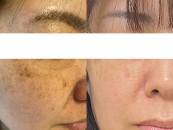 サクラ 本厚木駅前店(SAKURA)/本厚木ハーブピーリング