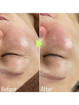 マロン(MARON)/ラミネーションピール