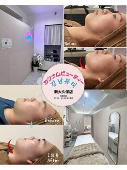 カンナムビューティー 新大久保店の写真/【韓国小顔マイクロ波リフト導入】韓国で人気爆発中!数週間で圧倒的小顔!驚きの低価格/結果重視を実現!