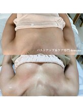 デミーナ(Demyna)/【バストアップ】症例 育乳