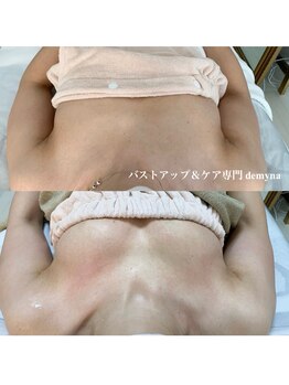デミーナ(Demyna)/【バストアップ】症例 育乳