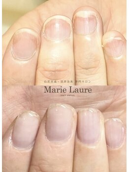 マリーロール 天王寺店(Marie Laure)/自爪育成/深爪矯正/ネイルケア