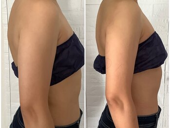 ビューティフルムーン(Beautiful Moon)/二の腕一撃コース・脂肪冷却