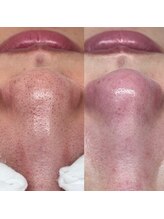 ライカブルー(RaicA BluE)/施術写真　before/after