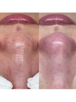 ライカブルー(RaicA BluE)/施術写真　before/after