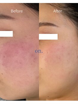 オン(on.)/《お客様症例》施術1回