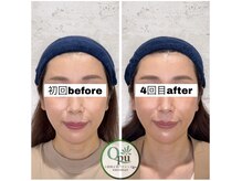 キュープ 相模原淵野辺店(Qpu)/たった4回で人生で1番小さな顔に