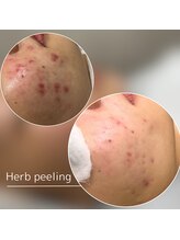 モモ(Momo.)/ハーブピーリング3回