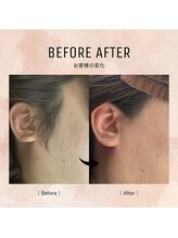 ルミエールブランシュ(Lumiere blanche)/顔脱毛