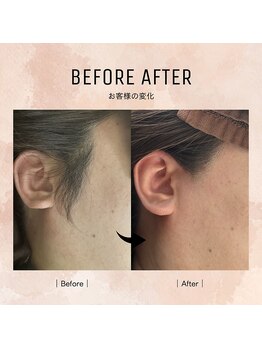 ルミエールブランシュ(Lumiere blanche)/顔脱毛