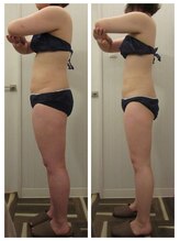パルティール(PARTIR)/◆痩身　症例写真