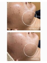 コンフィデンスサロン(Confidence Salon)/【症例】ニキビケア