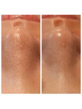 ラデュープラス(Radieux+)/韓国式3D毛穴洗浄