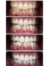 エクシアホワイトニング 日本橋店/スペシャルホワイトニング４回