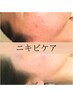 【ニキビケア/肌荒れ改善】ピーリング＋ビタミンC導入＋赤み鎮静パック