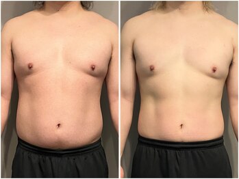 インプルーブ 浜北店(Improve)/2ヶ月でお腹周り-7.5ｃｍ！　