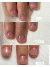 ハンド ケイ(Hand K)/自爪育成