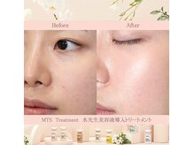 水光ピールトリートメント！肌悩み別アンプルで水光肌へ！