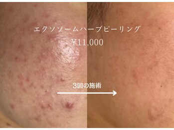 エイミー(Aimee)/ハーブピーリングのお手入れ