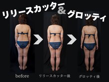 脂肪だけじゃない！ボディラインも同時に整う脂肪分解コース